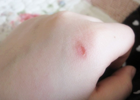 外傷引起的白癜風(fēng)都有哪些危害呢