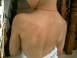 女兒背上有一塊白色的東西