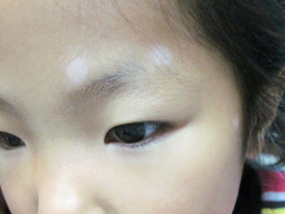 8歲兒童多處散發(fā)型白癜風(fēng)治好