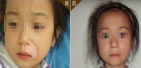 邢臺小孩背部白癜風癥狀有哪些