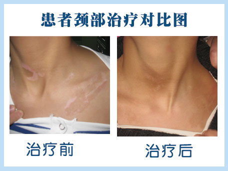 邢臺白癜風有哪些癥狀