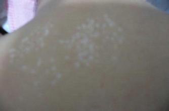 盛夏時節，眾多蚊蟲來襲，小心感染皮膚!