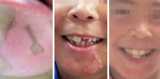 青少年白癜風(fēng)這樣治好的更快!