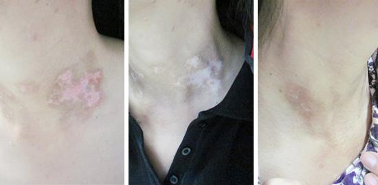 減肥不當,患上白癜風