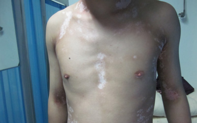 有沒有前胸白癜風治好的案例