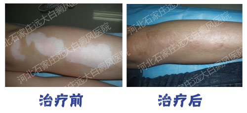 自體組織工程皮膚移植術正式落戶遠大白癜風醫院