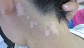 4.15白癜風(fēng)防治日暨白斑免費(fèi)普查活動(dòng)開啟