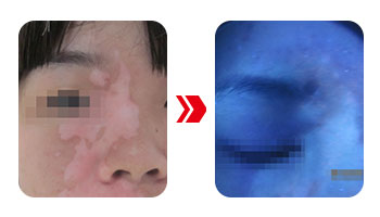 4.15白癜風(fēng)防治日暨白斑免費(fèi)普查活動(dòng)開啟