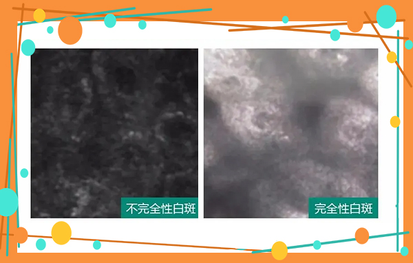 6.25世界白癜風日—“拒絕歧視，共抗白斑”普查援助活動