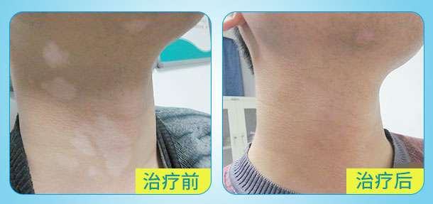 新年送祝福!元旦白癜風診療援助活動開啟!