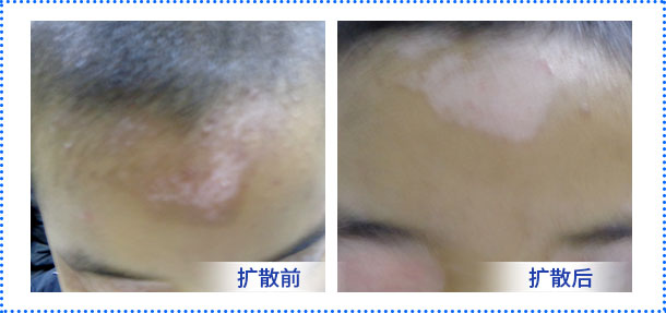 春季白斑0元普查暨北京白癜風診療醫(yī)師—祝清華教授親臨會診