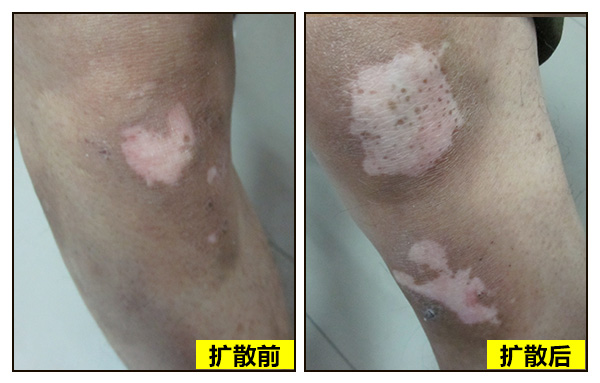 北京醫(yī)師來啦!!特邀北京白癜風醫(yī)師——蘇有明教授將于4月5日來院會診