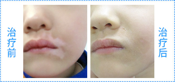 脾多肽注射液聯合308nm準分子激光治療白癜風臨床療效評估