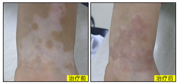 盛夏放心祛白北京白癜風醫師會診即將開啟,白癜風患者的福音!