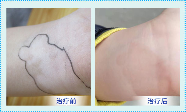 京冀白癜風專家暑期會診暨白斑0元公益普查 助力青少年兒童白癜風患者迎接美好青春！