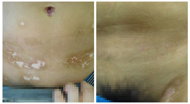 【醫德高尚暖人心,醫術精湛傳四方】白癜風康復患者送來感謝錦旗