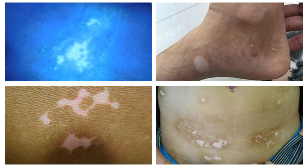 【醫德高尚暖人心,醫術精湛傳四方】白癜風康復患者送來感謝錦旗