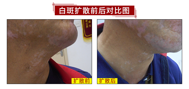 健康中秋·秋季白癜風(fēng)診療惠民活動開啟!