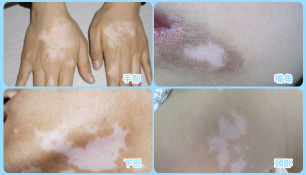 喜迎國慶,金秋送健康北京白癜風醫師大型會診援助活動啟動!