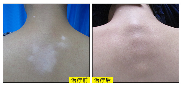 喜迎國慶,金秋送健康北京白癜風醫師大型會診援助活動啟動!