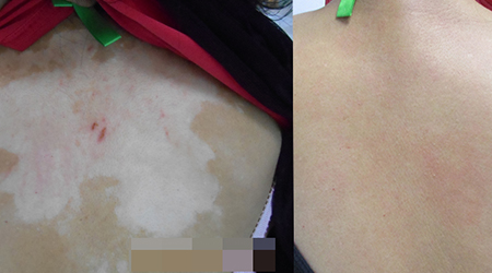 石家莊遠(yuǎn)大 元旦惠民診療援助開啟!看白斑更省錢!