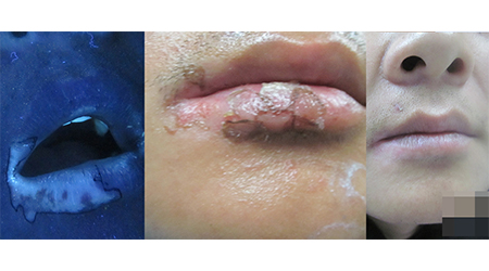 石家莊遠(yuǎn)大 元旦惠民診療援助開啟!看白斑更省錢!