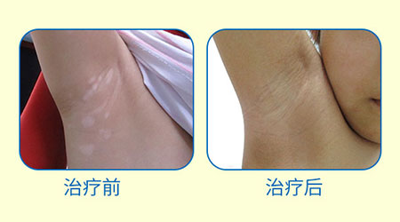 陽(yáng)春三月·抗白復(fù)發(fā)——遠(yuǎn)大白斑抗復(fù)發(fā)活動(dòng)開(kāi)啟!