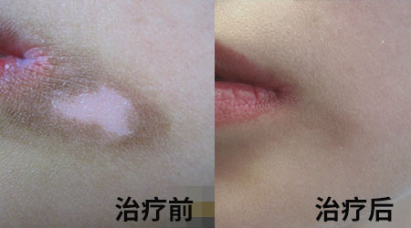 清明小長假，2022春季白斑抗復發診療援助活動開啟！