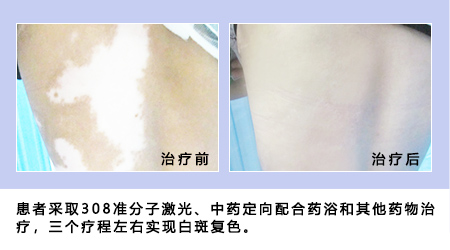 415全國白癜風防治日“遠大白斑診療援助活動開啟!”