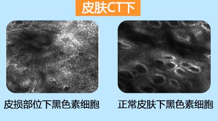 五一關愛全民皮膚健康,到院領取價值2240元白斑診療金!