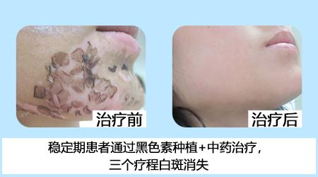 五一關愛全民皮膚健康,到院領取價值2240元白斑診療金!