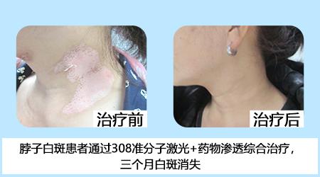 五一關愛全民皮膚健康,到院領取價值2240元白斑診療金!