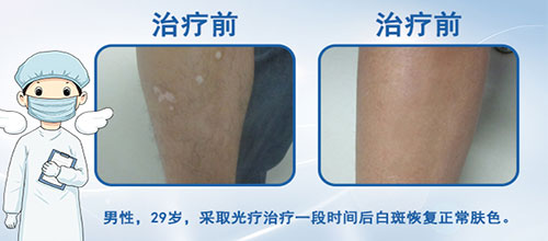 美國極速308nm準分子激光治療系統成功落戶!患者到院可享免費治療一次!