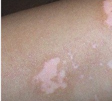 治好的兒童白癜風如何預防復發?