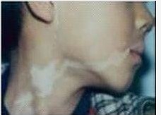 白癜風患者怎么做才能不擴散?