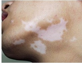 怎么預(yù)防白癜風(fēng)復(fù)發(fā)效果好?