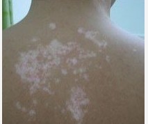 白癜風這種病癥如何預防呢