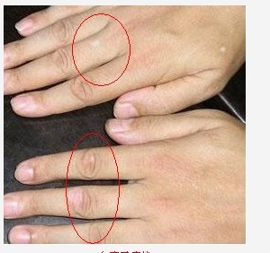 怎么做能預防白癜風的復發?