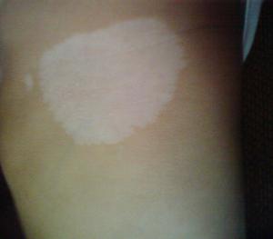 冬天怎么防止白癜風擴散