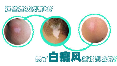 夏季如何預防白癜風出現在身上