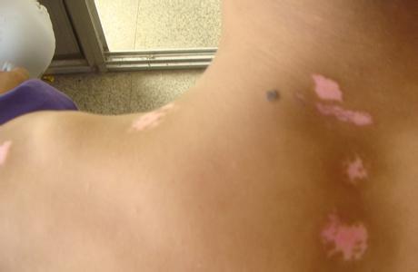 白癜風患者是否可以使用遮蓋液治療白斑