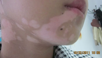 冬季患者怎樣預防白癜風