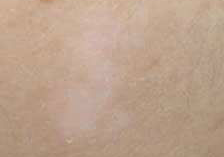 白癜風危害不容小覷，四個方面精準預防白癜風