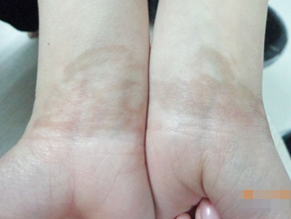 女性手臂白癜風案例