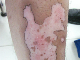 男性腿部白癜風案例