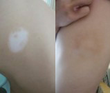 張家口身上的白斑去哪能確診