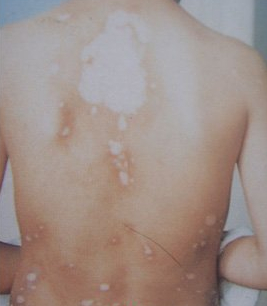 張家口白癜風(fēng)醫(yī)院后背白癜風(fēng)咋治療