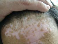 邯鄲成安縣如何對成人白癜風進行診斷和鑒別?