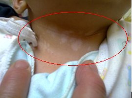 檢查什么項目可以確定白斑是不是白癜風