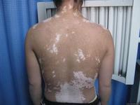 外傷為什么導致白癜風加重?